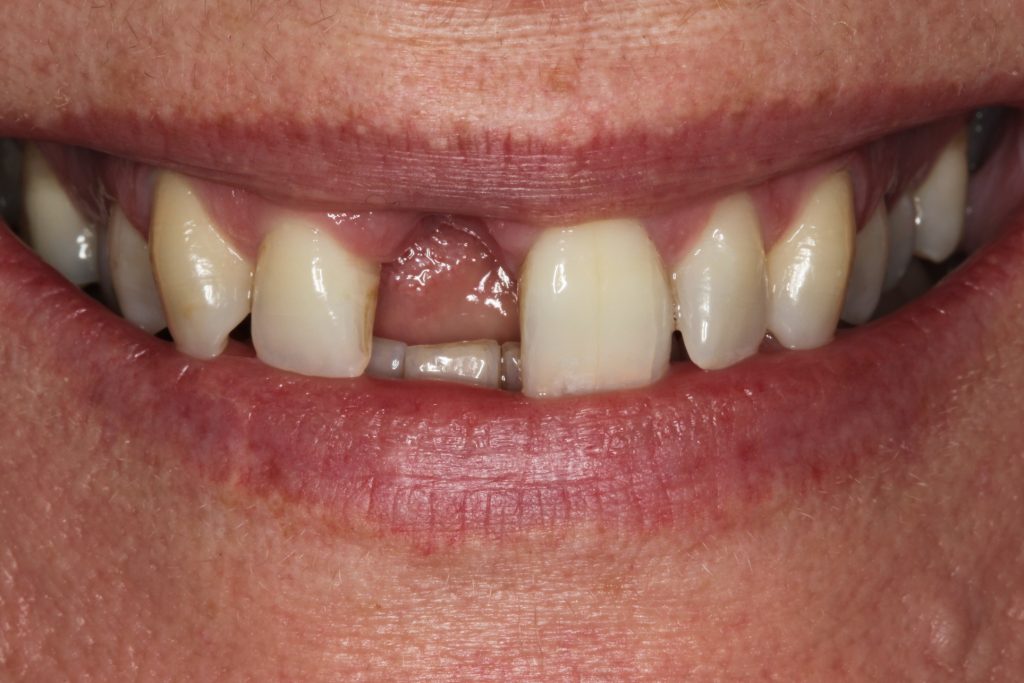 Having A Dental Implant And Wondering What The Item Numbers For Health