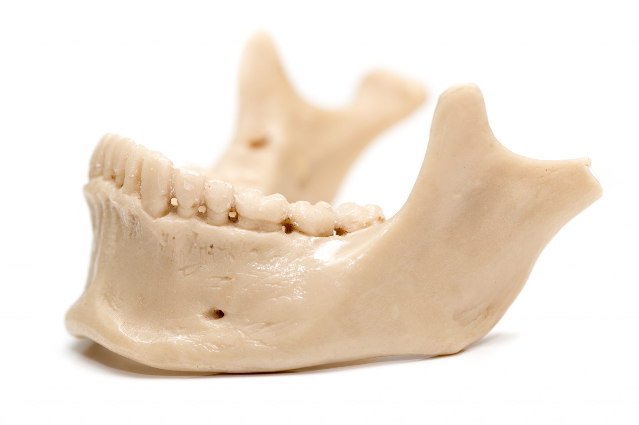 Deterioration of Jawbone