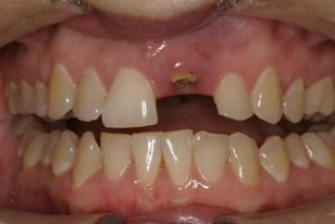Before-