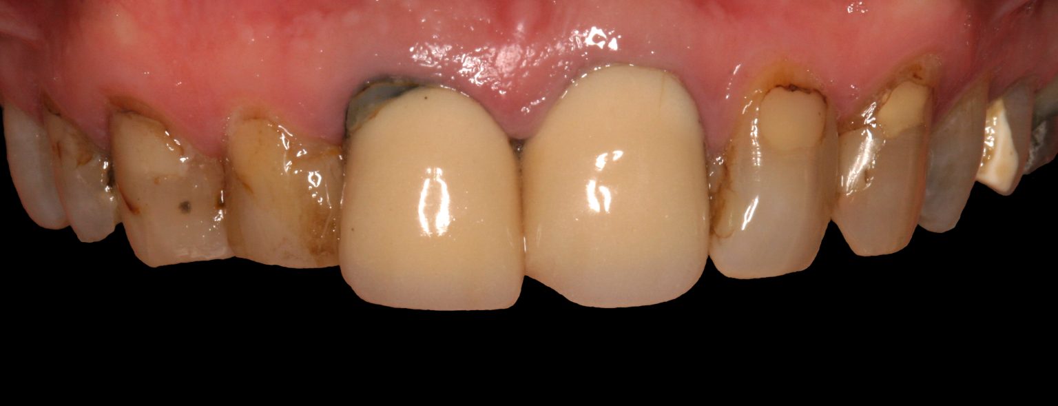 Dental Crowns & Dental Crowns Cost In Sydney Care Dentistry